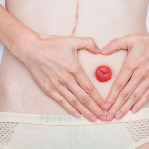 Colostomías - Dr Nicolás Betancur - Coloproctólogo